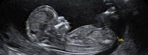 aborto